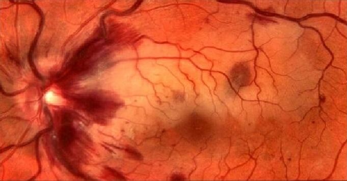Blood vessels of retina and vision recovery